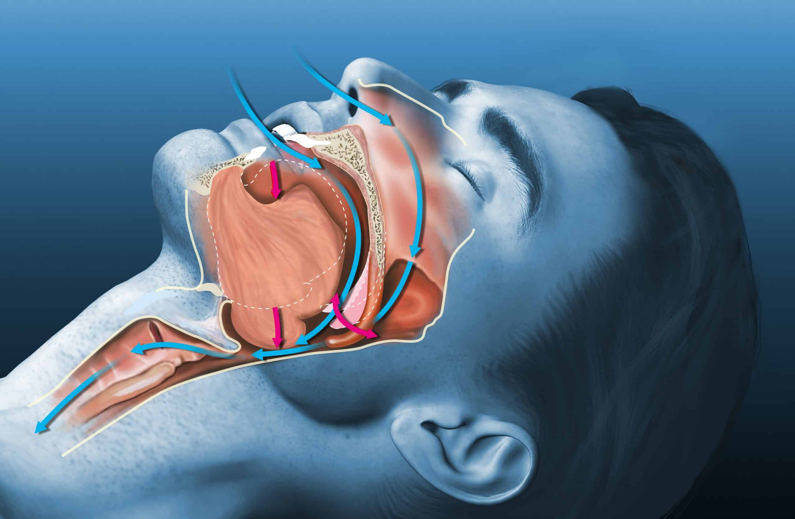 Apnée Sociale : Comment les Week-ends de Vie en Altitude Peuvent Aggraver l'Apnée du Sommeil