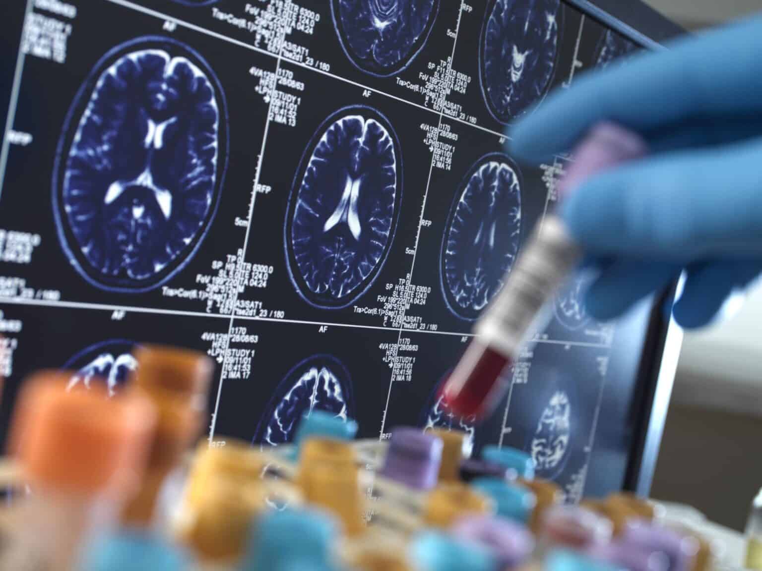 Alzheimer : un test sanguin capable de prédire la maladie des années ...