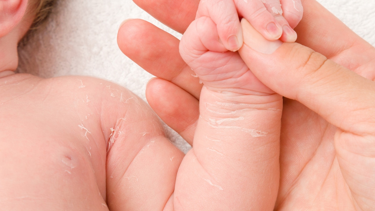 Peau sèche du nouveau-né : causes et remèdes
